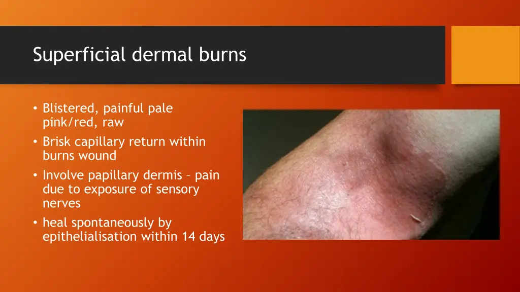 superficial dermal burns