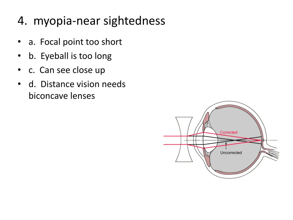 4 myopia near sightedness