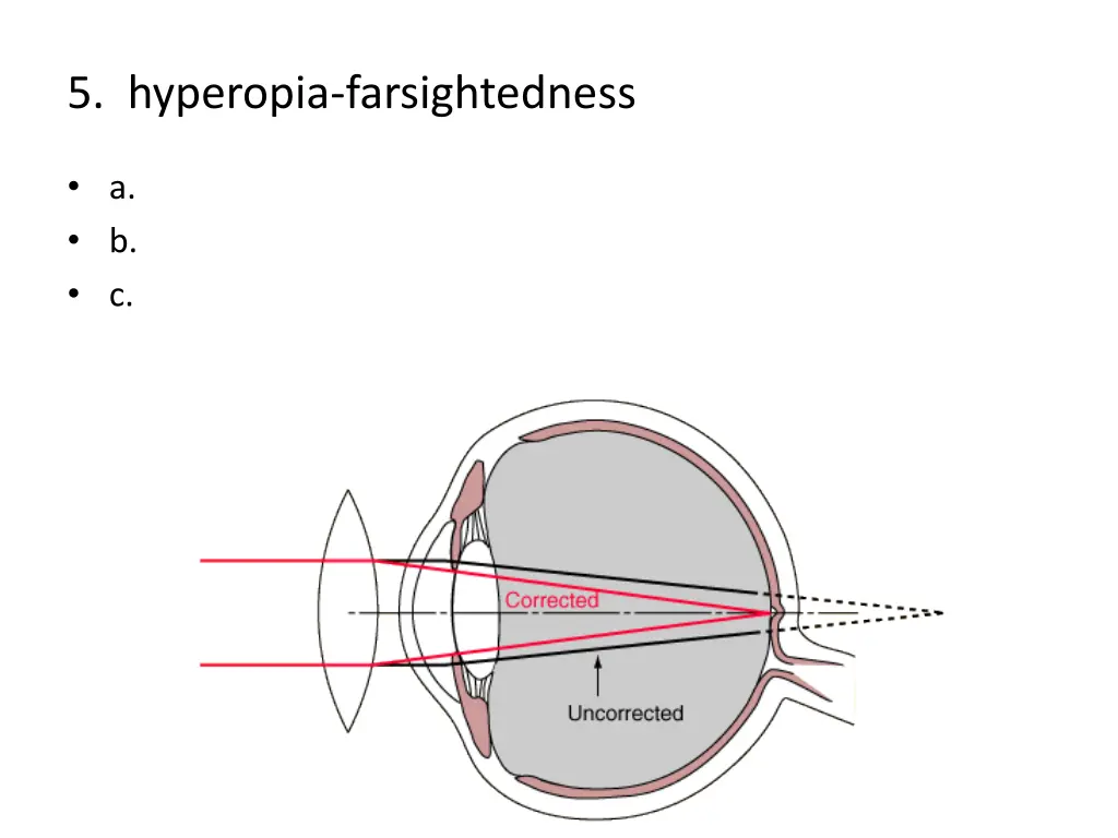 5 hyperopia farsightedness