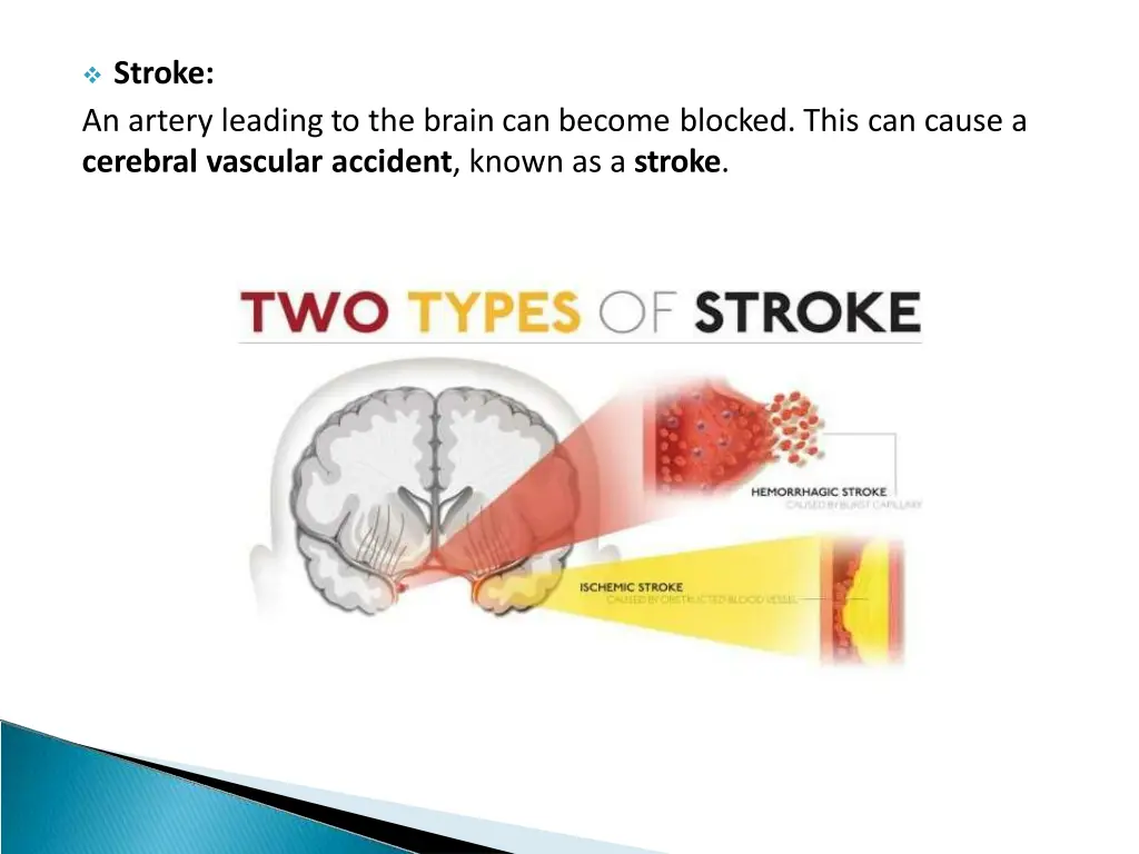 stroke an artery leading to the brain can become