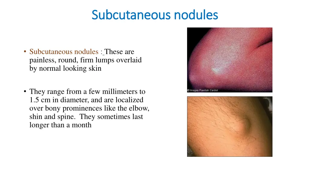 subcutaneous nodules subcutaneous nodules