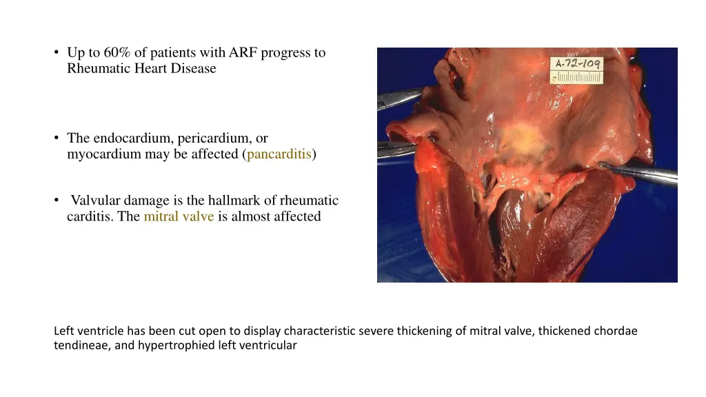 up to 60 of patients with arf progress