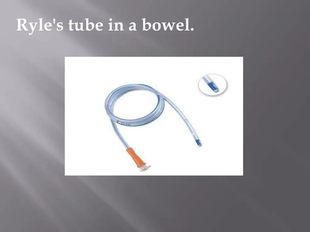 ryle s tube in a bowel