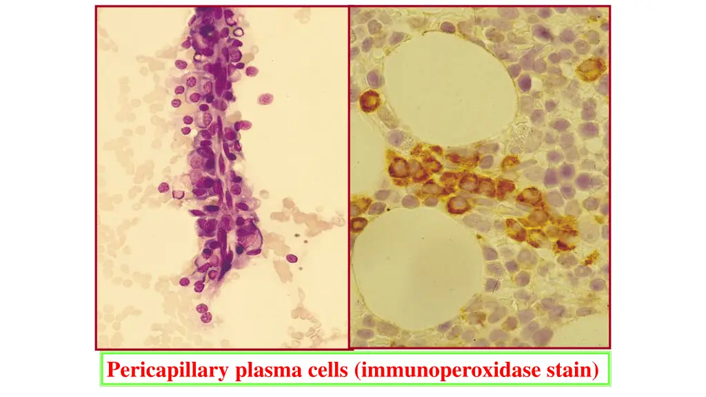 pericapillary plasma cells immunoperoxidase stain