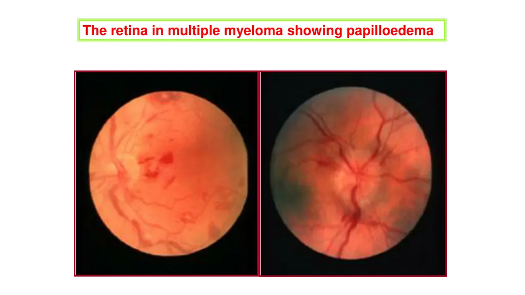 the retina in multiple myeloma showing
