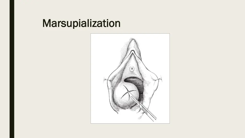 marsupialization marsupialization 2