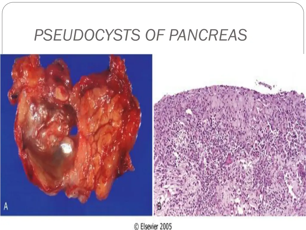 pseudocysts of pancreas 2