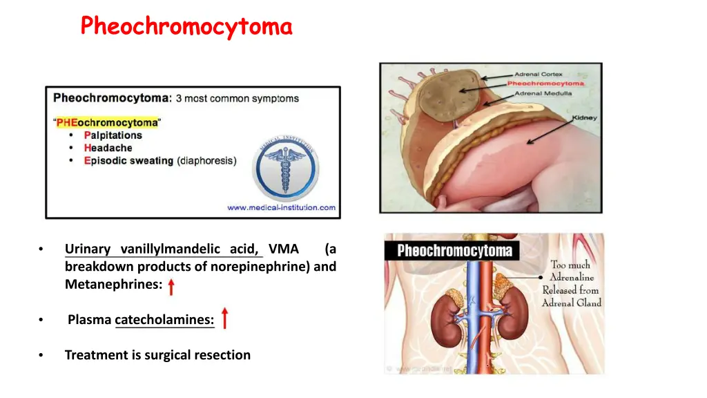 pheochromocytoma 1