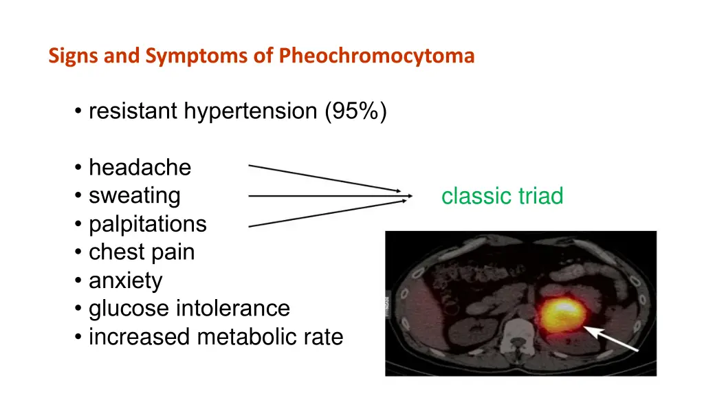 signs and symptoms of pheochromocytoma