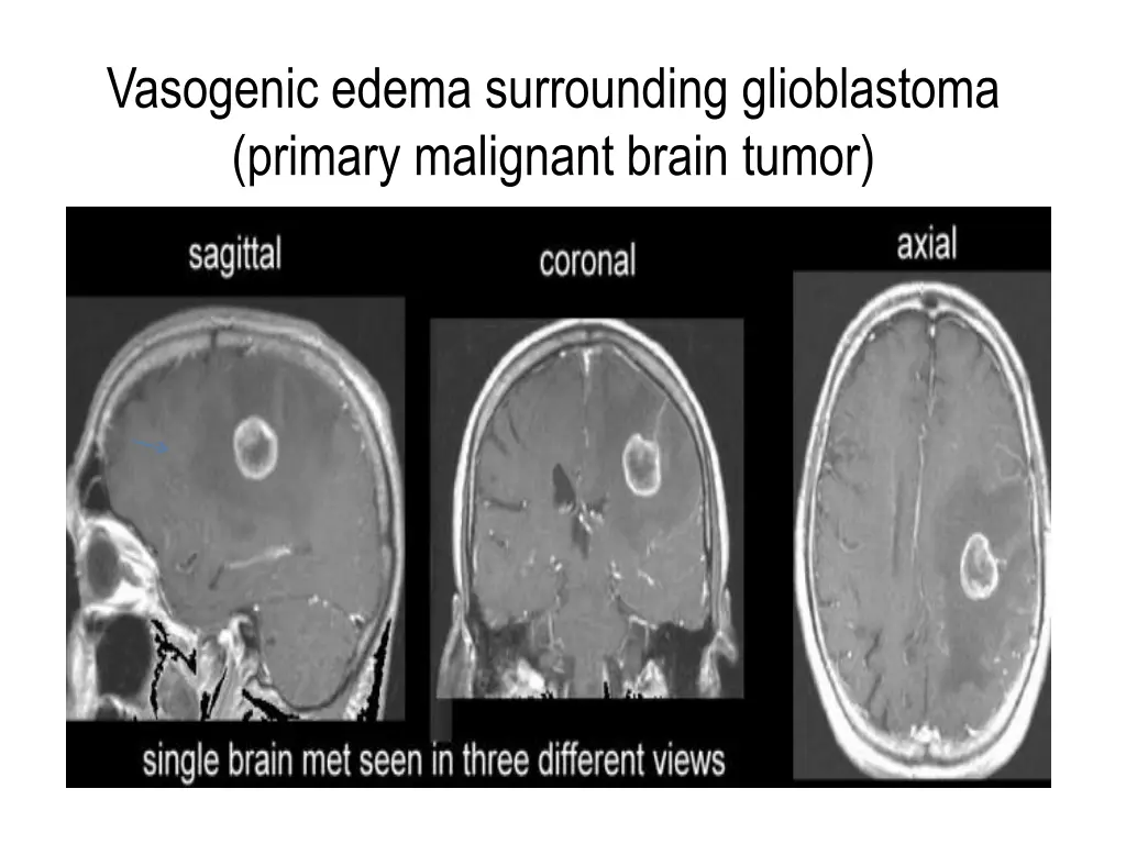 vasogenic edema surrounding glioblastoma primary