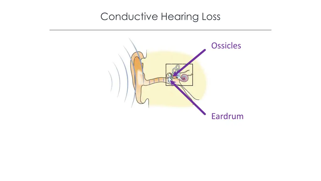conductive hearing loss