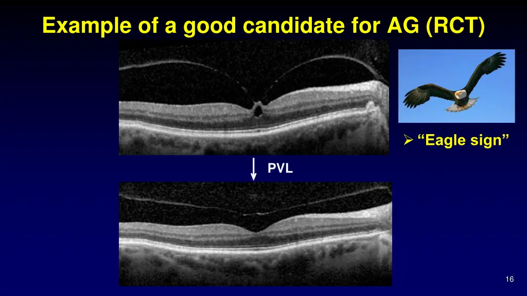 example of a good candidate for ag rct