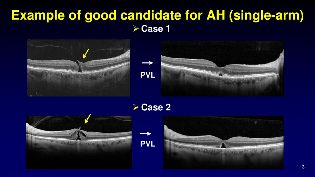 example of good candidate for ah single arm case 1