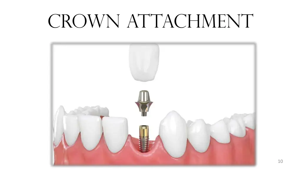 crown attachment