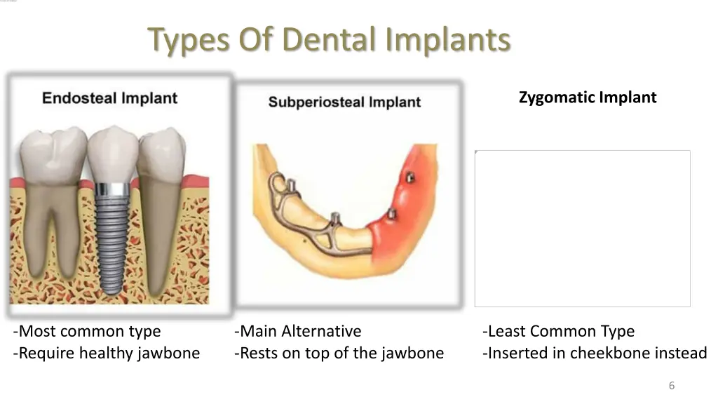 types of dental implants