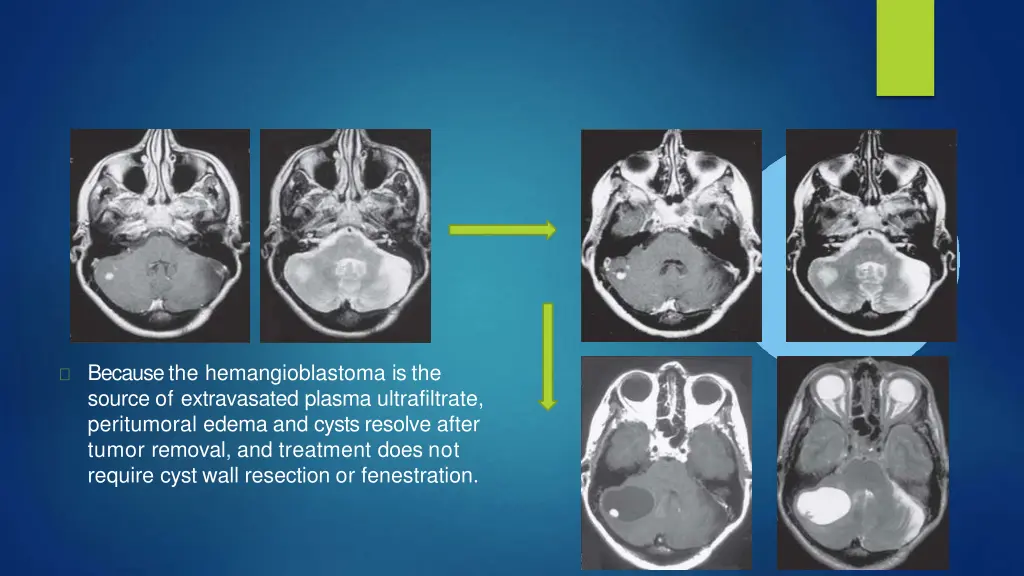 because the hemangioblastoma is the source