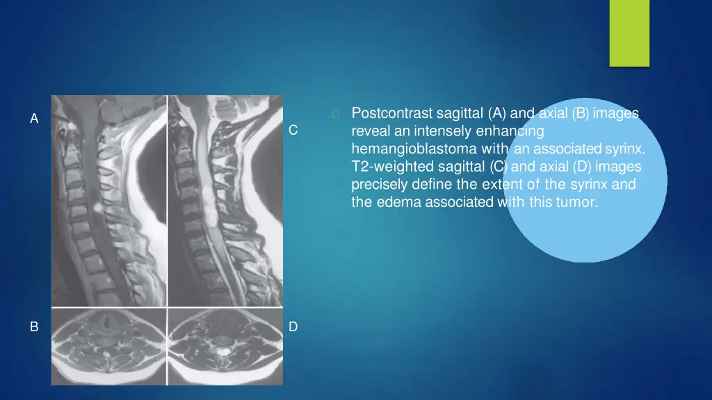 postcontrast sagittal a and axial b images reveal