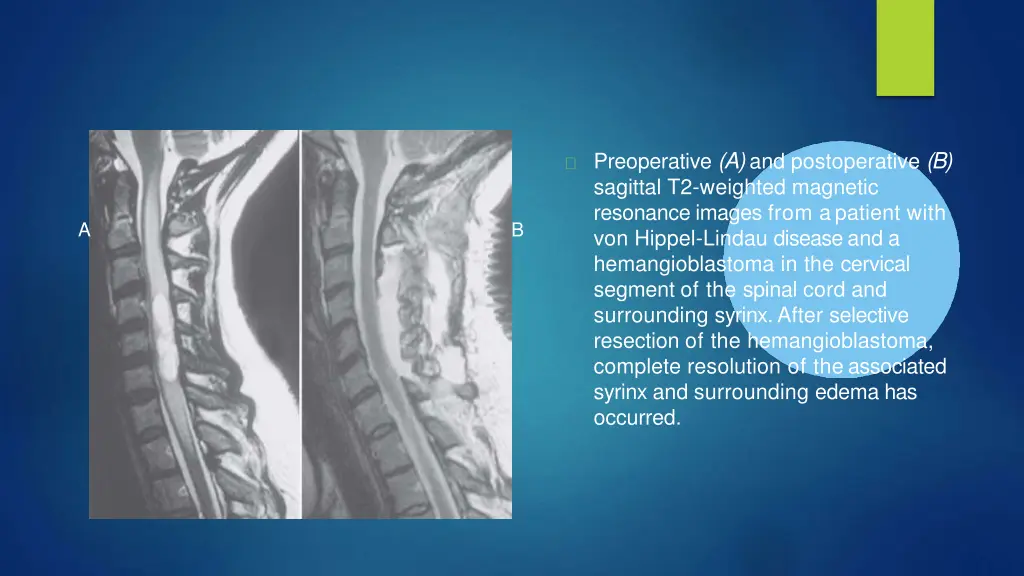 preoperative a and postoperative b sagittal