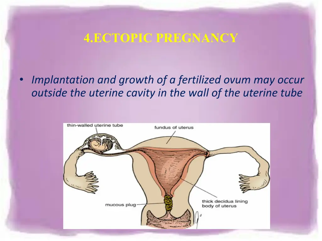 4 ectopic pregnancy