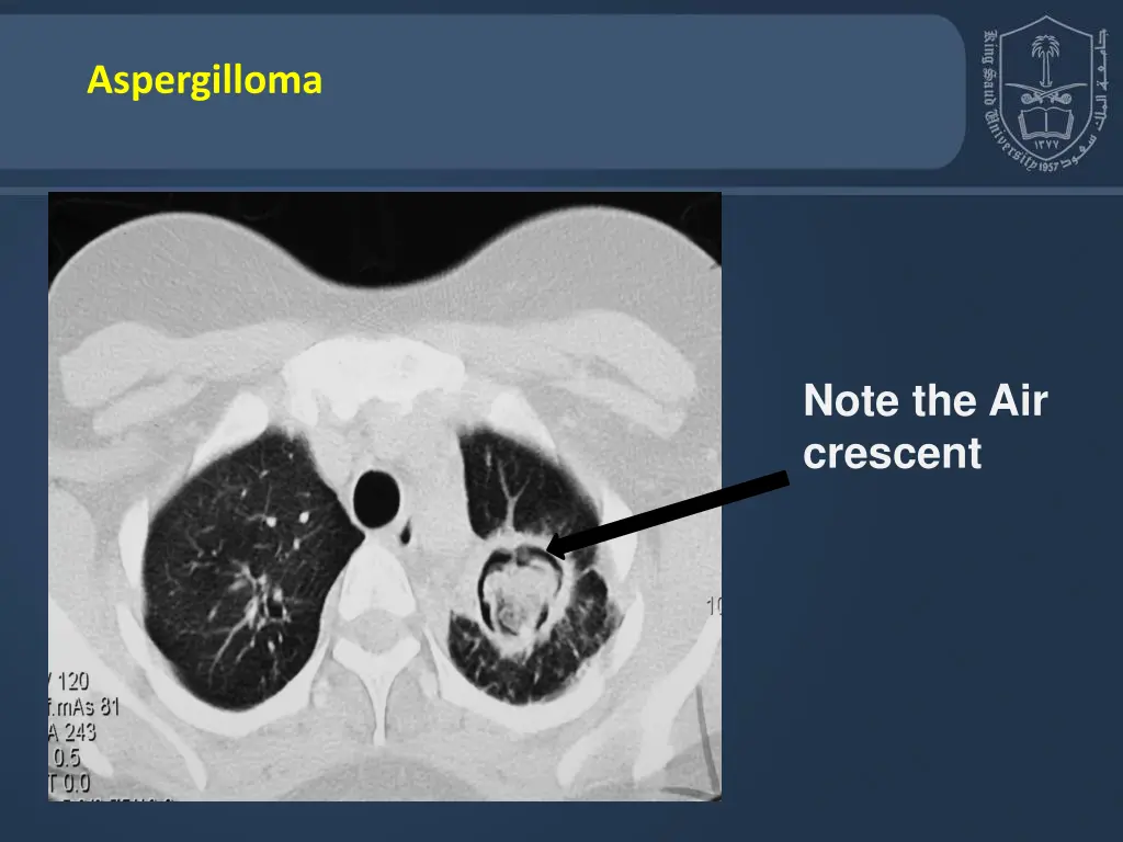 aspergilloma