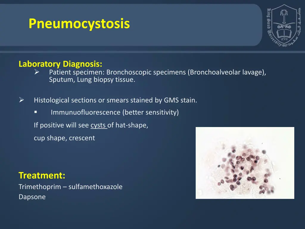 pneumocystosis