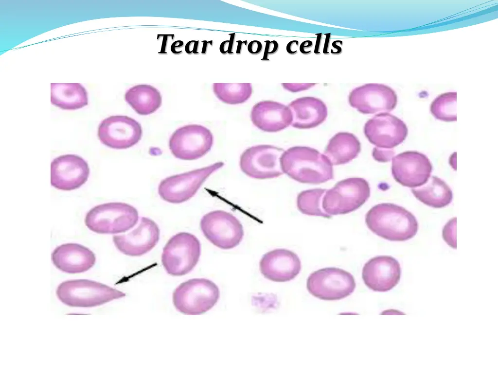 tear drop cells