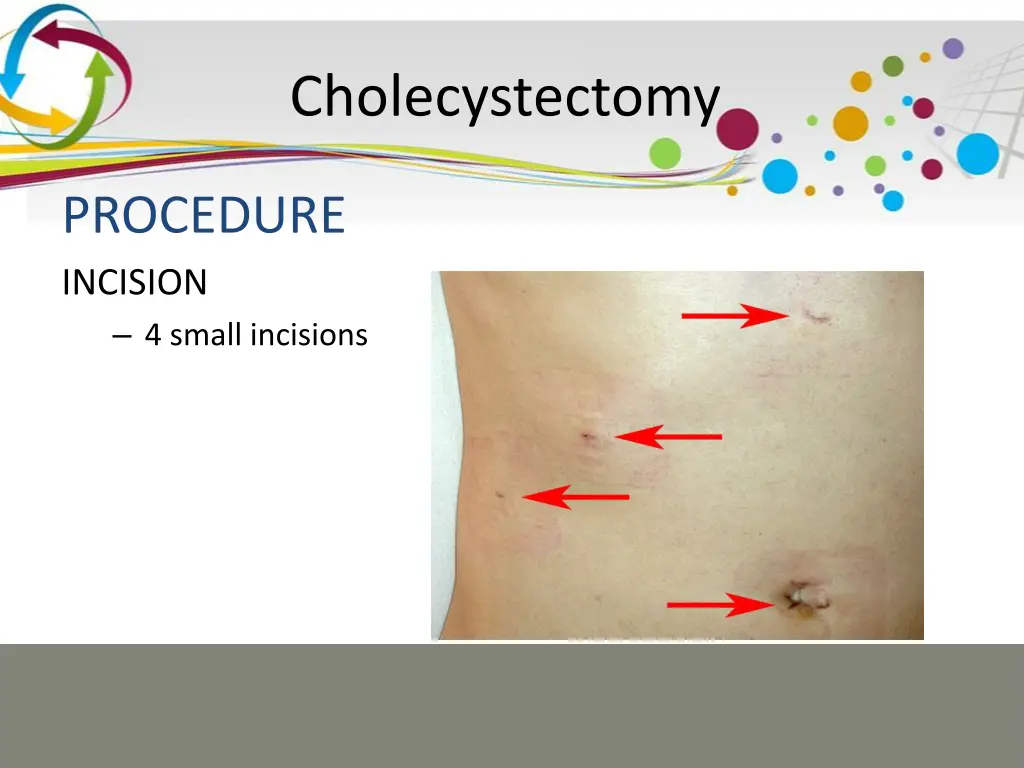 cholecystectomy 8