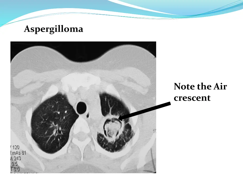 aspergilloma