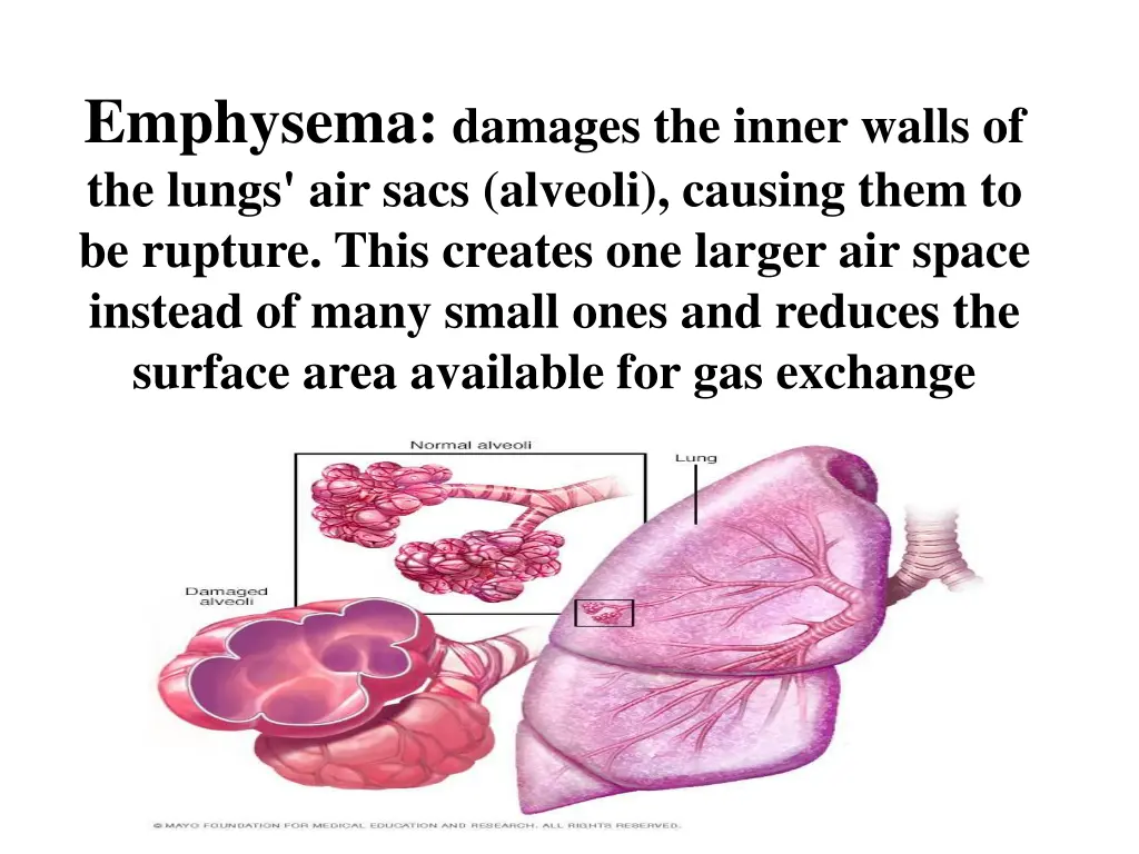 emphysema damages the inner walls of the lungs