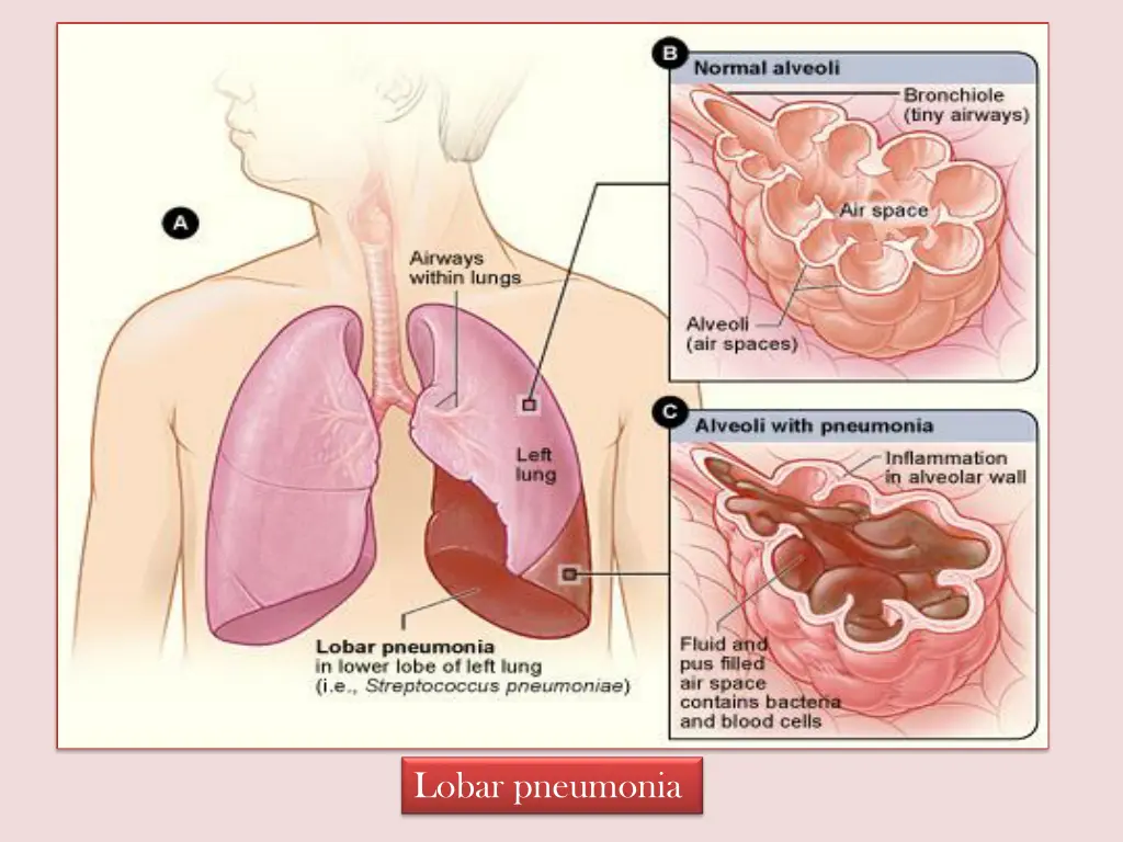 lobar pneumonia