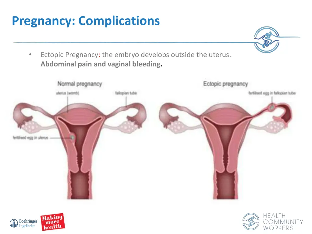 pregnancy complications 1
