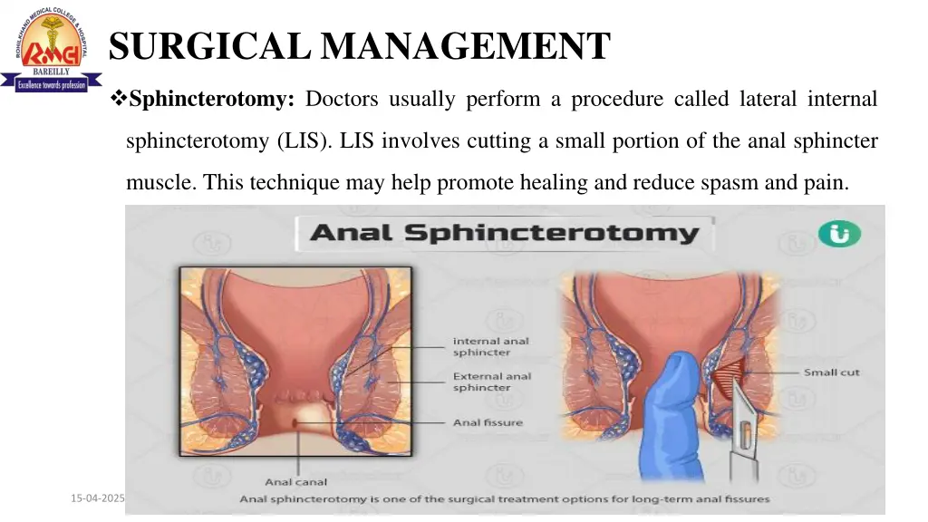 surgical management