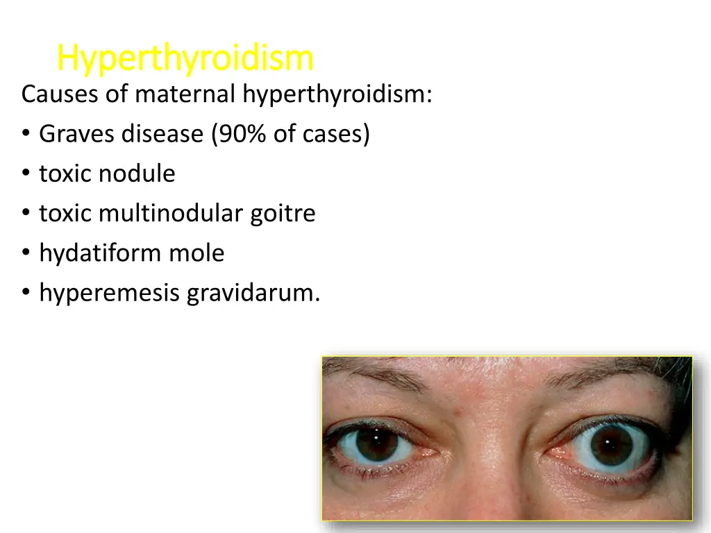 hyperthyroidism hyperthyroidism causes