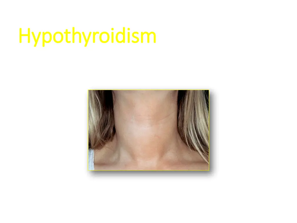 hypothyroidism hypothyroidism