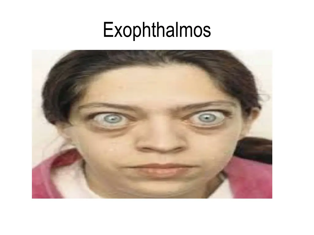 exophthalmos