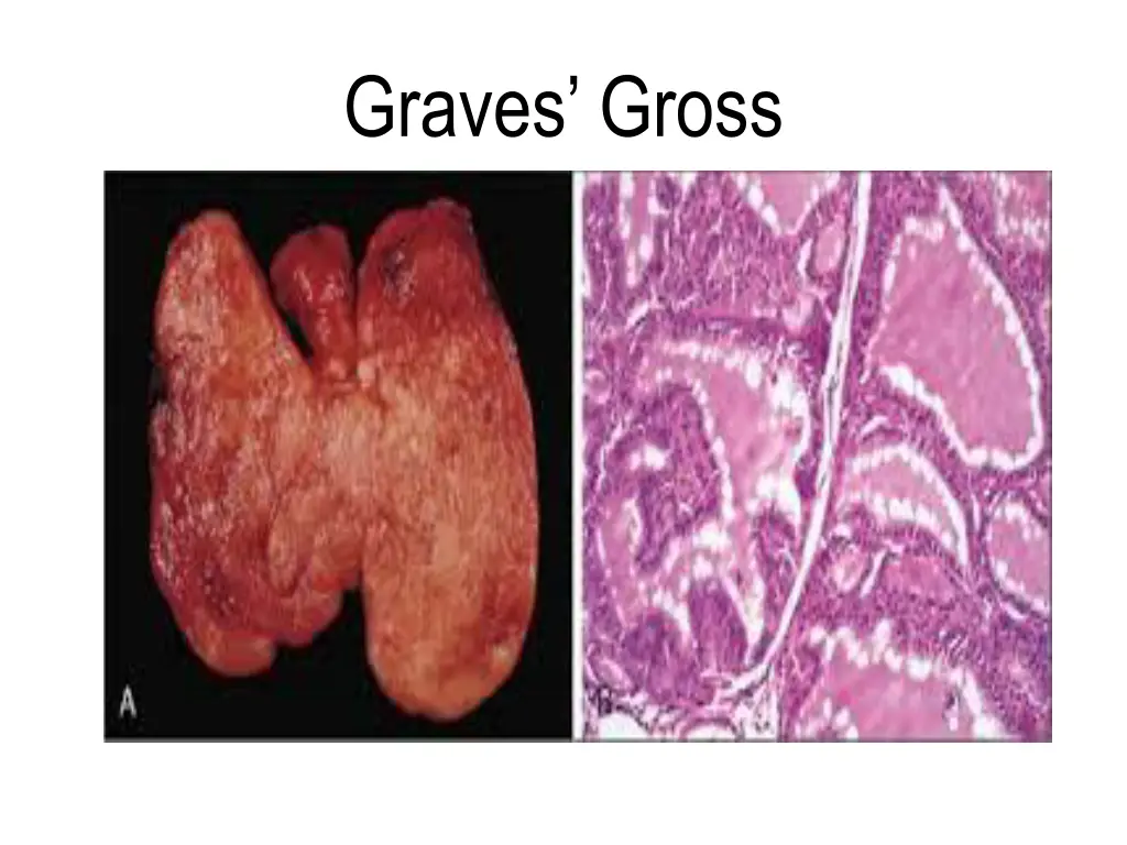 graves gross