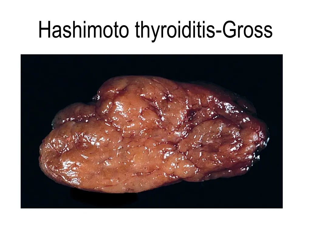 hashimoto thyroiditis gross