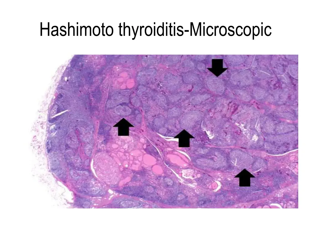 hashimoto thyroiditis microscopic