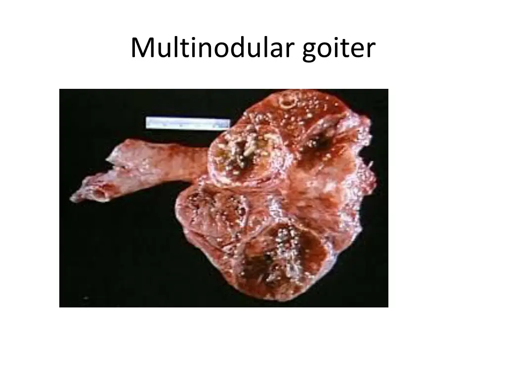 multinodular goiter 1