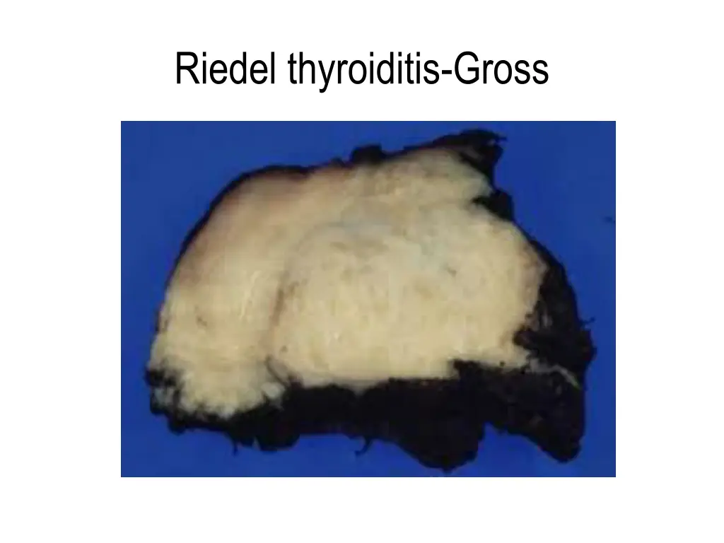 riedel thyroiditis gross