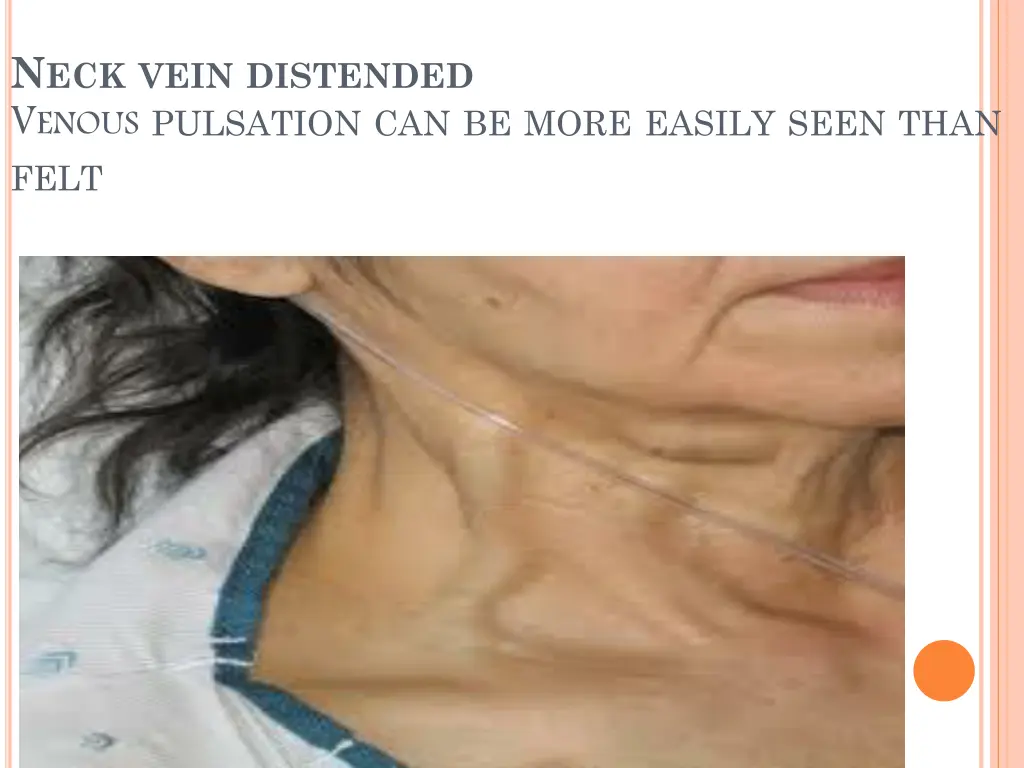 n eck vein distended v enous pulsation