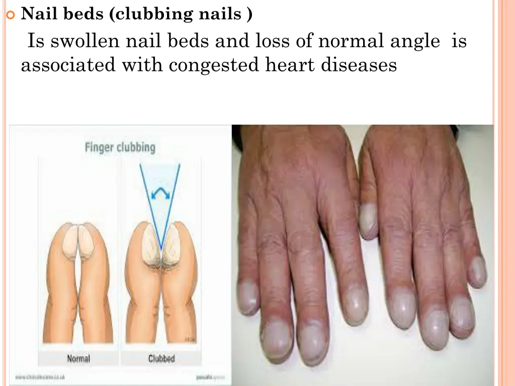 nail beds clubbing nails is swollen nail beds