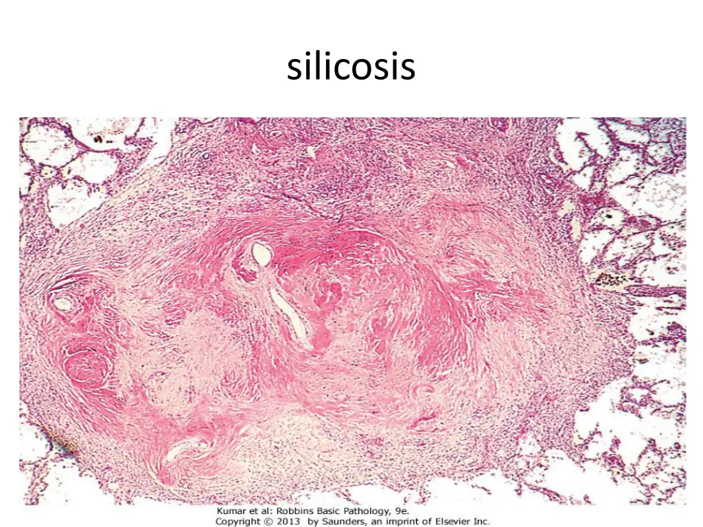 silicosis