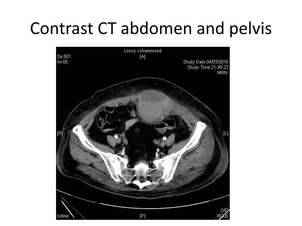 contrast ct abdomen and pelvis