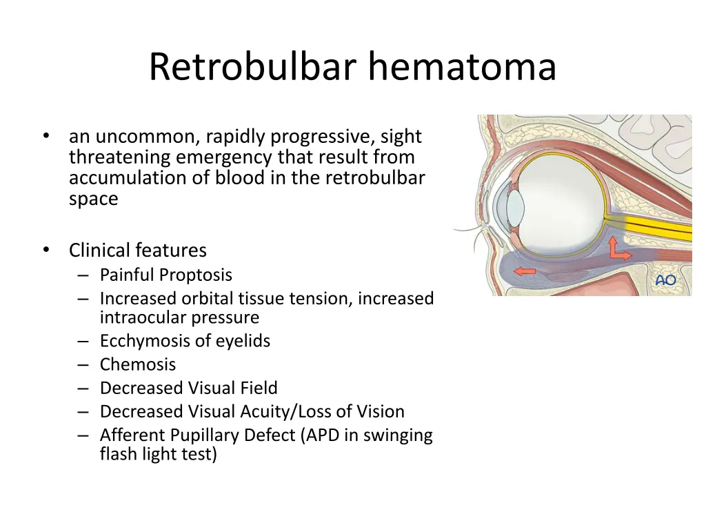 retrobulbar hematoma