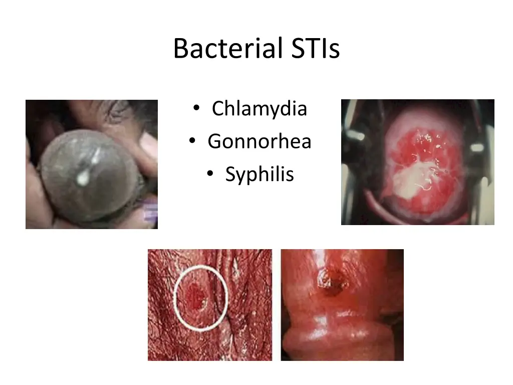 bacterial stis