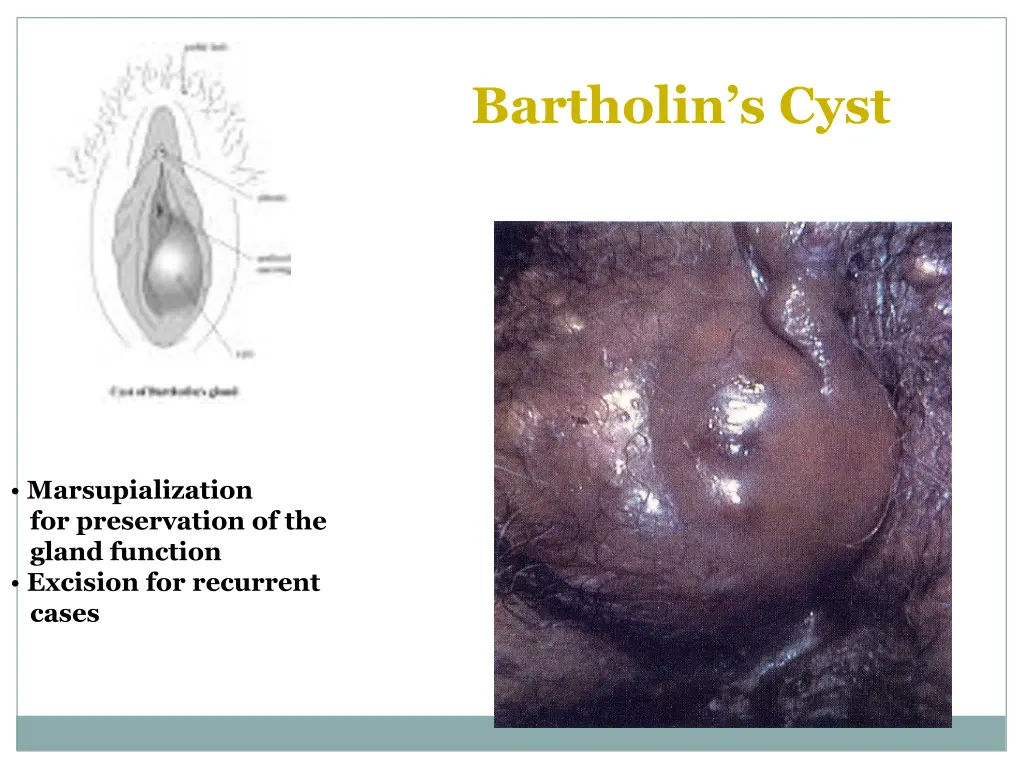 bartholin s cyst