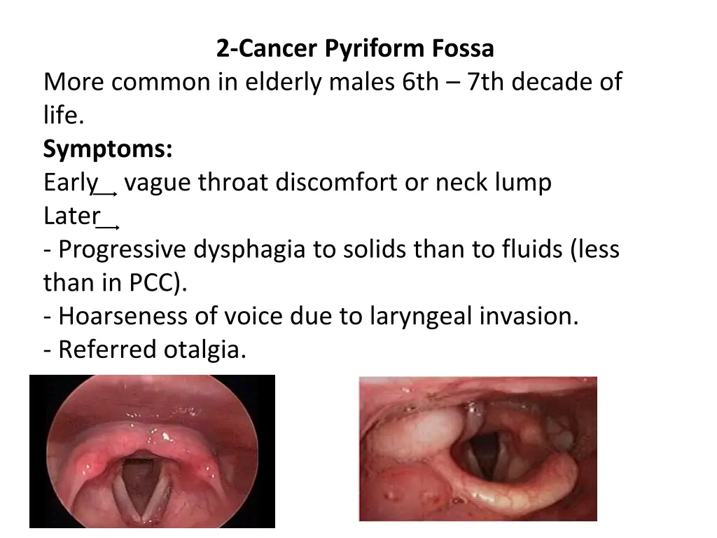 2 cancer pyriform fossa