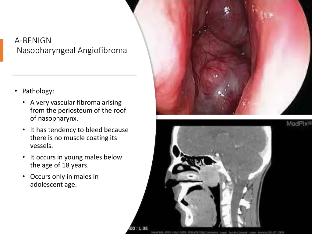 a benign nasopharyngeal angiofibroma