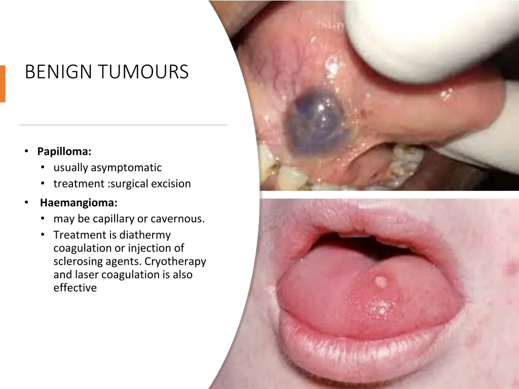 benign tumours